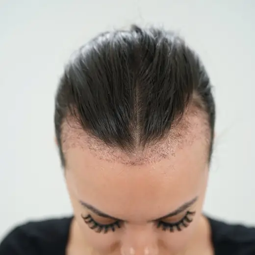 Voor haartransplantatie, Allaya Lammens