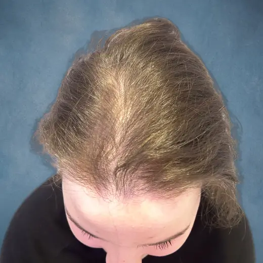 Na haartransplantatie, Cliënt