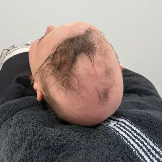 Voor haartransplantatie, Cliënt