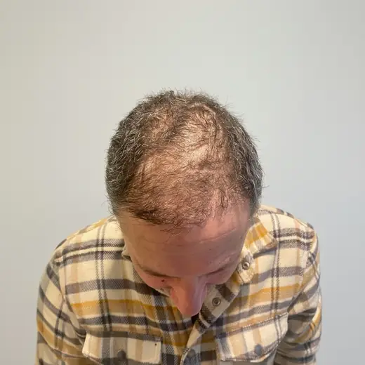 Voor haartransplantatie, Augustin Fernández Espinosa