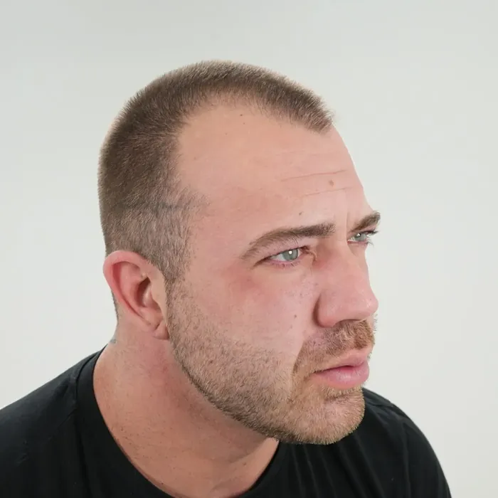 Bas Doeven, voor de haartransplantatie