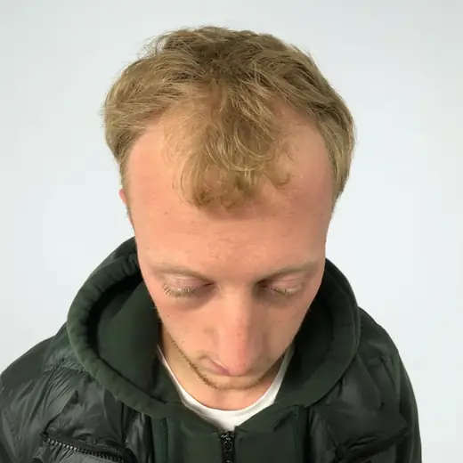 Voor haartransplantatie, Boy Van Niel
