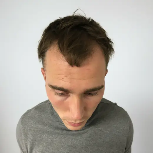 Voor haartransplantatie, Clint Ouwendijk