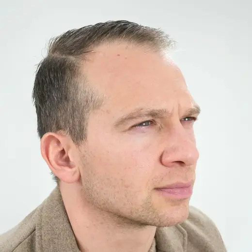 Voor haartransplantatie, Danny Sulkers