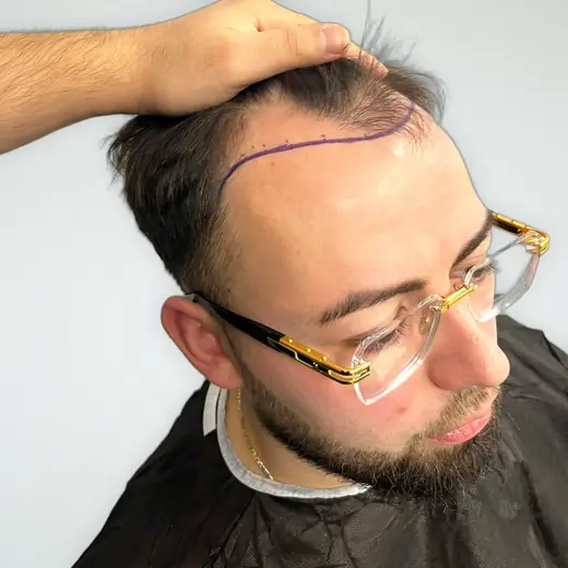 Voor haartransplantatie, Dennis Oost