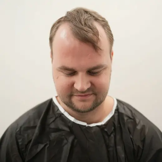 Voor haartransplantatie, Dennis Schmidt