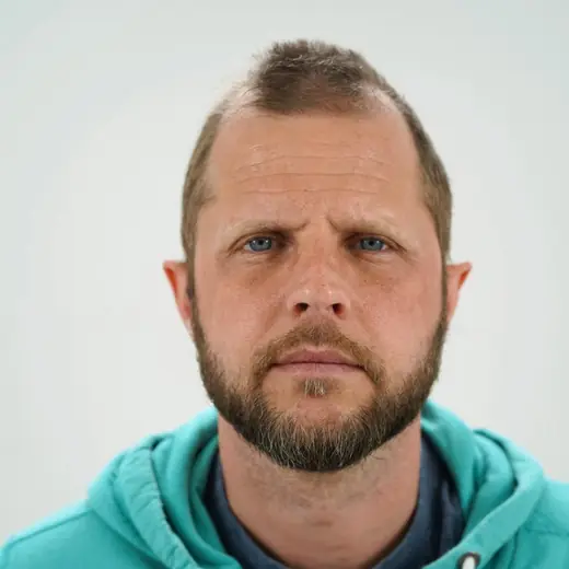 Voor haartransplantatie, Dieter Segaert
