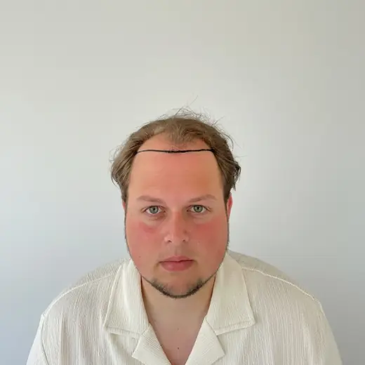 Voor haartransplantatie, Dion van den Heuvel
