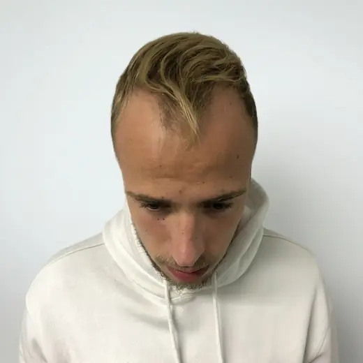 Voor haartransplantatie, Dylan