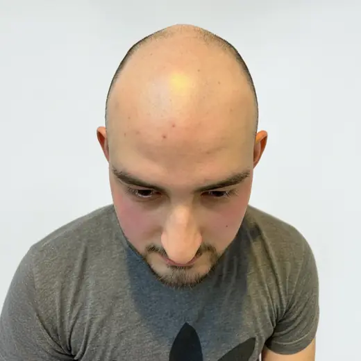 Voor haartransplantatie, Ferhan Ozer
