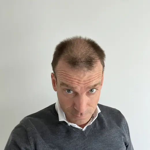 Voor haartransplantatie, Frans Jan Hellental