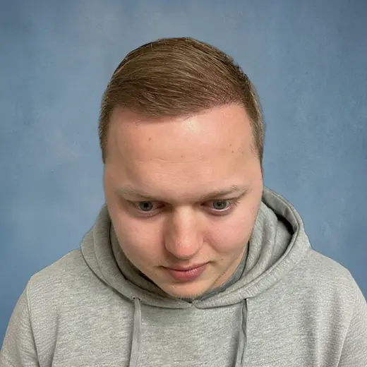 Na haartransplantatie, Cliënt