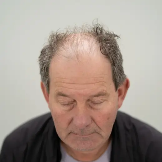 Voor haartransplantatie, Henk Van Eldijk