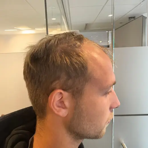 Voor haartransplantatie, Jay Herman