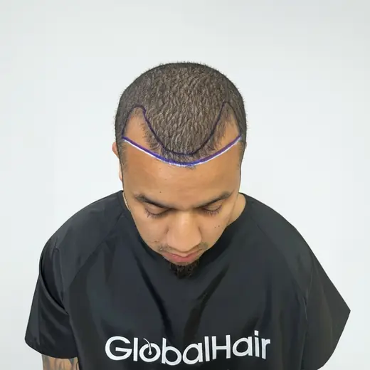 Voor haartransplantatie, Jay Nabibux