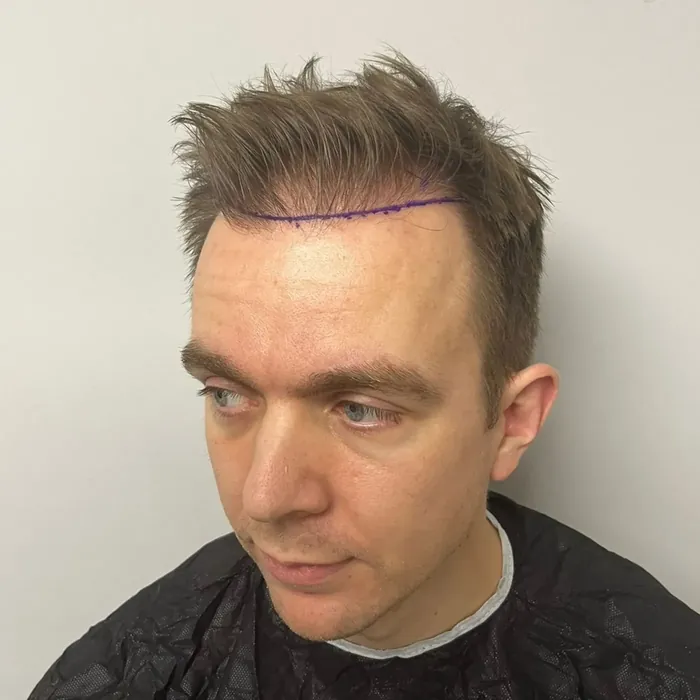 Johan Den Dulk, voor de haartransplantatie
