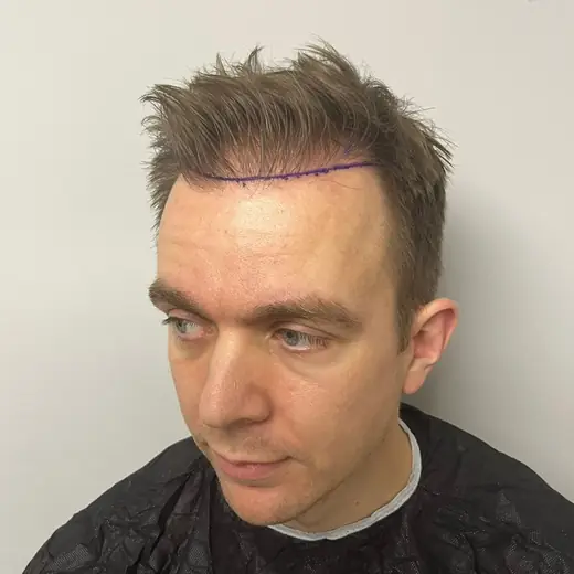 Voor haartransplantatie, Johan Den Dulk