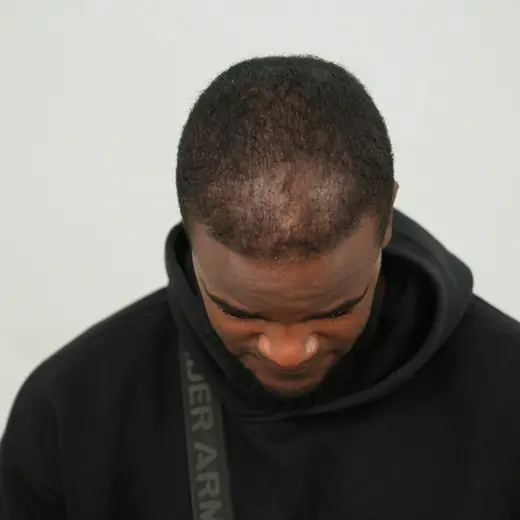 Voor haartransplantatie, Jonathan Antonio