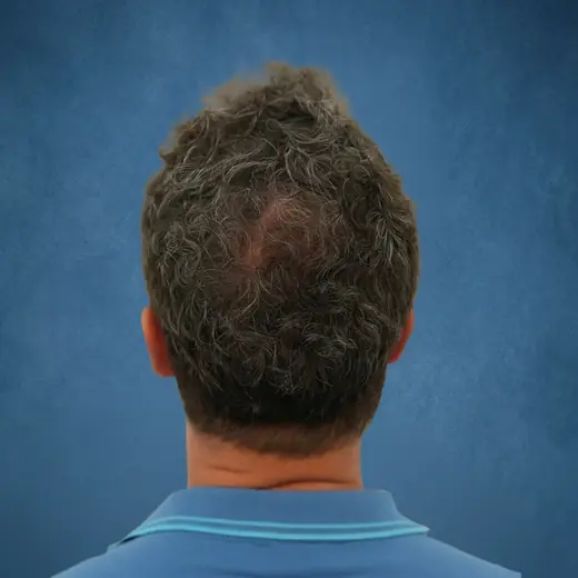 Na haartransplantatie, Kevin Potters