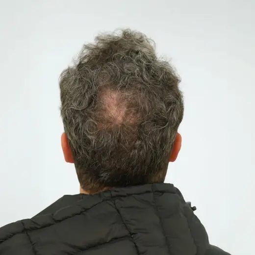 Voor haartransplantatie, Kevin Potters