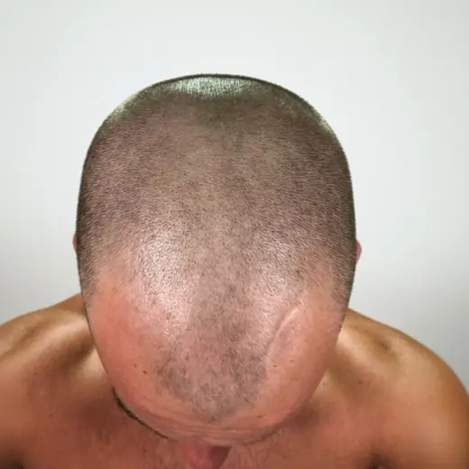 Voor haartransplantatie, Lars Van Kempen