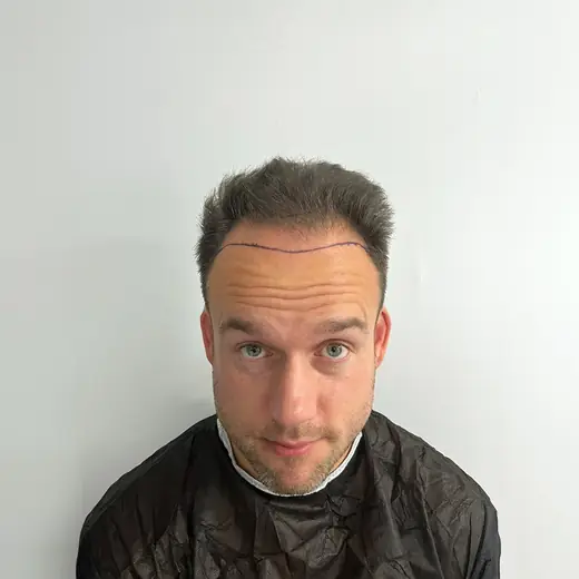 Voor haartransplantatie, Luuc Bovens
