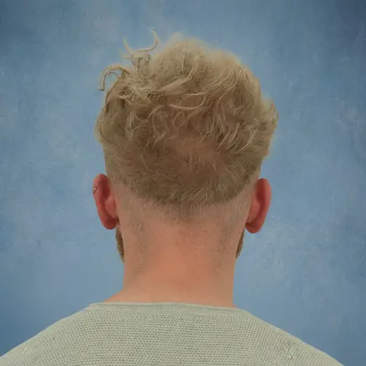 Na haartransplantatie, Luuk Bremer