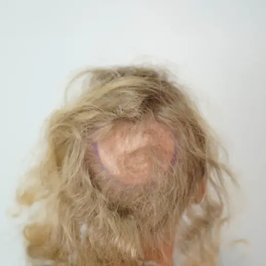 Voor haartransplantatie, Luuk Bremer