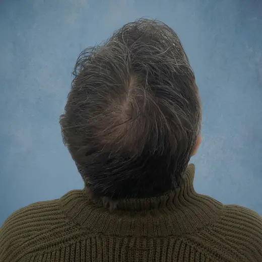 Na haartransplantatie, Cliënt