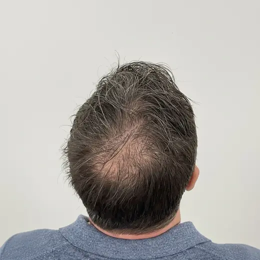 Voor haartransplantatie, Cliënt