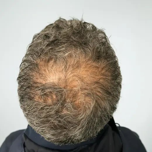 Voor haartransplantatie, Cliënt