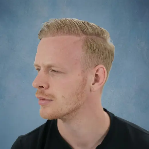 Na haartransplantatie, Marc (Scholten)