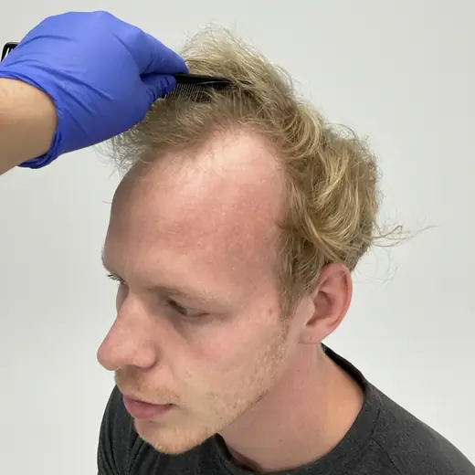Voor haartransplantatie, Marc (Scholten)