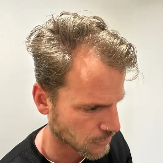 Voor haartransplantatie, Marijn Kuller