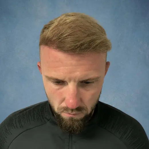 Na haartransplantatie, Martijn