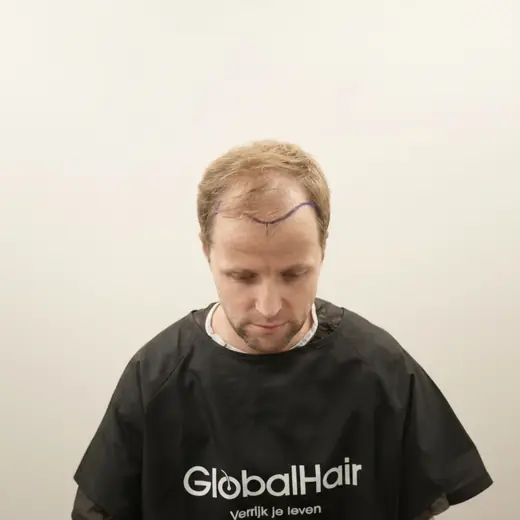 Voor haartransplantatie, Matthijs Koppe