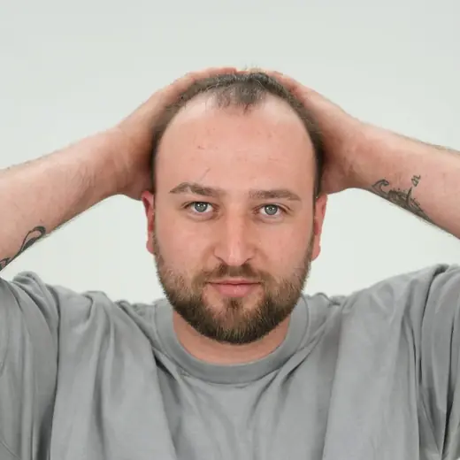 Voor haartransplantatie, Melvin Blaich
