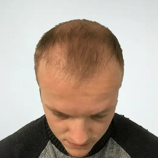Voor de behandeling, Melvin