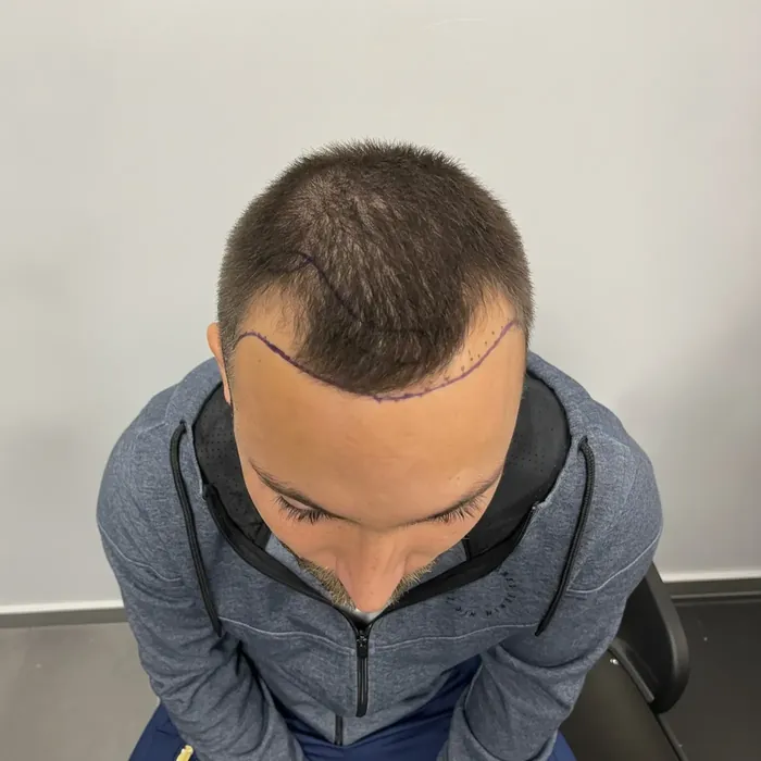 Michael De Maat, voor de haartransplantatie