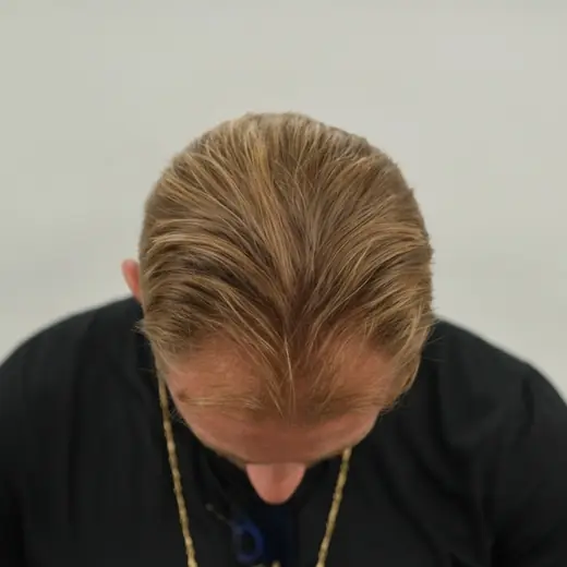Voor haartransplantatie, Mike Van Beurden