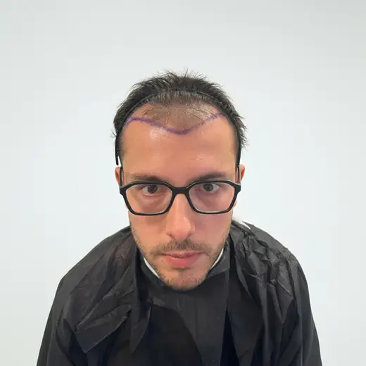 Voor haartransplantatie, Mitchel van Hove
