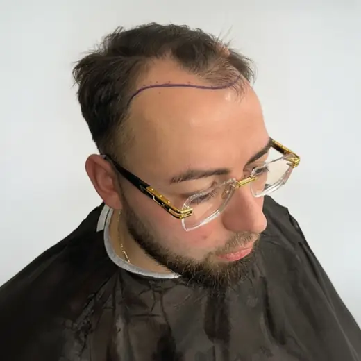 Voor haartransplantatie, Cliënt