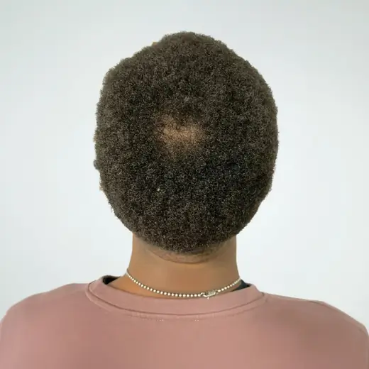 Voor haartransplantatie, Cliënt