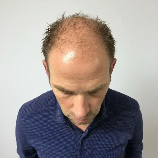 Voor haartransplantatie, Rijnsburg