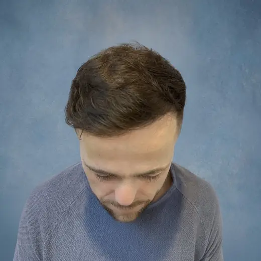 Na haartransplantatie, Sander Klopstra