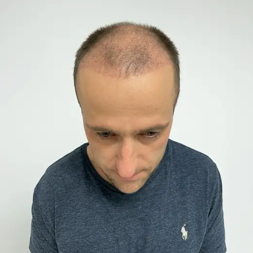 Voor haartransplantatie, Sander Klopstra