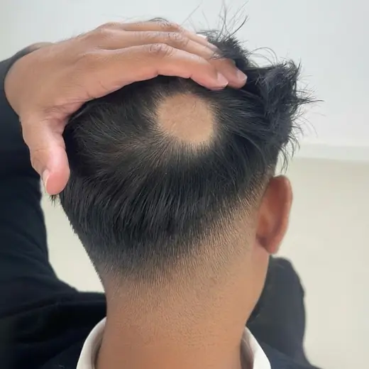 Voor haartransplantatie, Cliënt