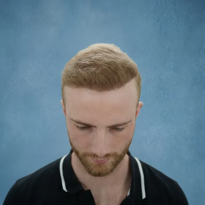 Steven Gangelhof, na de haartransplantatie