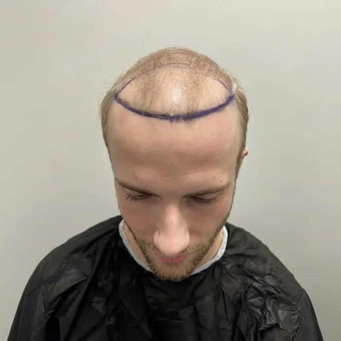 Steven Gangelhof, voor de haartransplantatie