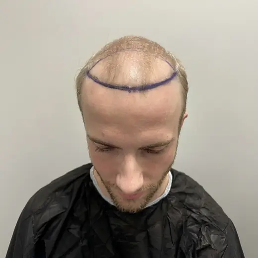 Voor de behandeling, Steven Gangelhof